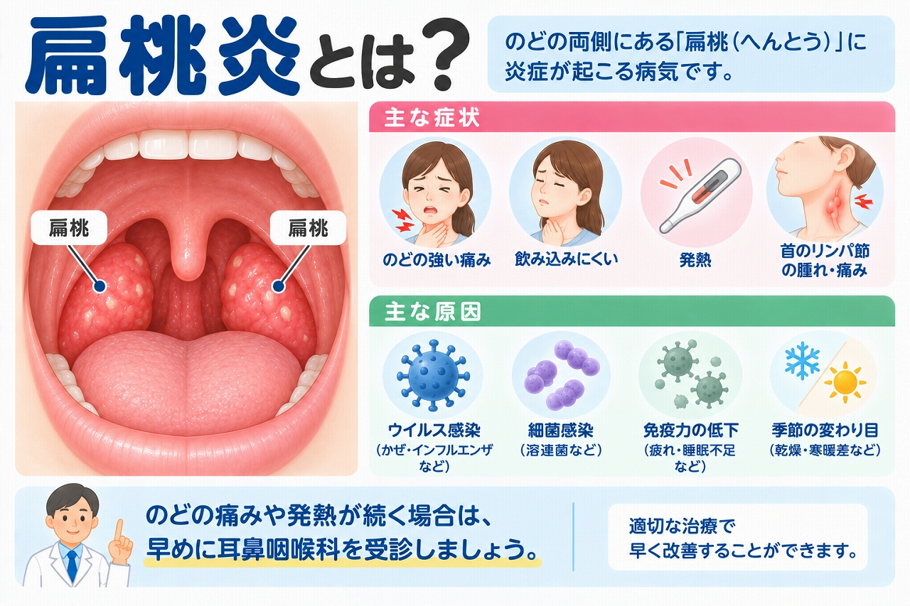 扁桃炎の原因や症状を解説したインフォグラフィック。のどの両側にある扁桃に炎症が起こり、強いのどの痛み、飲み込みにくさ、発熱、首のリンパ節の腫れなどが現れることや、ウイルス・細菌感染などの主な原因を紹介