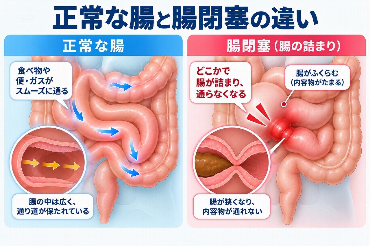 正常な腸と腸閉塞の違いを比較し、正常では食べ物や便・ガスがスムーズに通るのに対し、腸閉塞では腸が詰まって内容物が通過できず、手前の腸がふくらむ状態を示した図