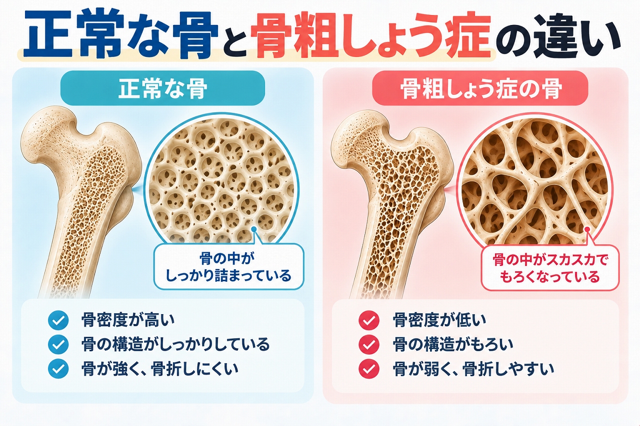 正常な骨と骨粗しょう症の骨を比較し、正常な骨は内部構造が密で強度が保たれているのに対し、骨粗しょう症では骨密度が低下して内部がスカスカになり、骨がもろく骨折しやすくなる様子を示した図