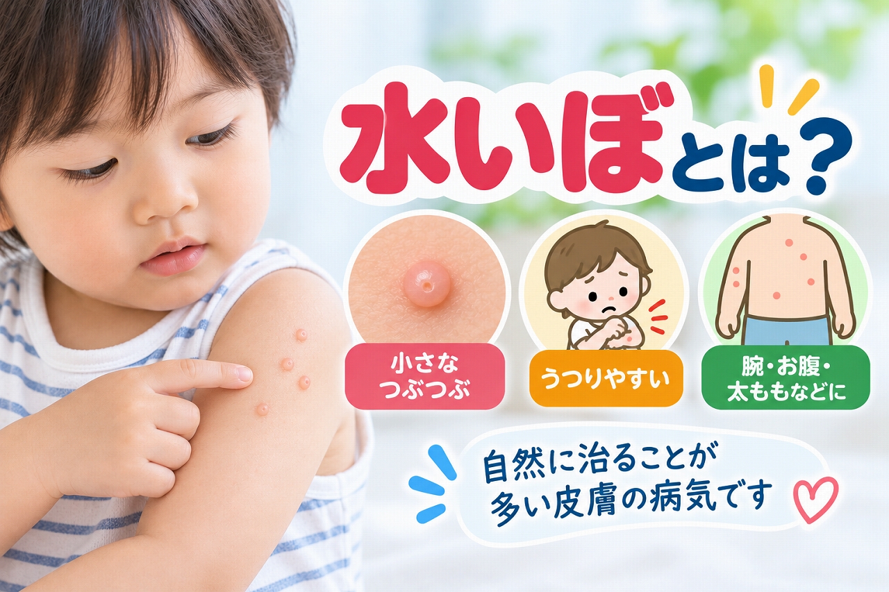 水いぼ（伝染性軟属腫）の症状と感染の特徴を解説した小児科医療インフォグラフィック。腕に小さな光沢のあるブツブツがみられる幼児の写真と、中央がくぼんだ丘疹の拡大図を配置。接触による感染、腕・お腹・太ももなどの好発部位、自然治癒することが多い特徴を図解。