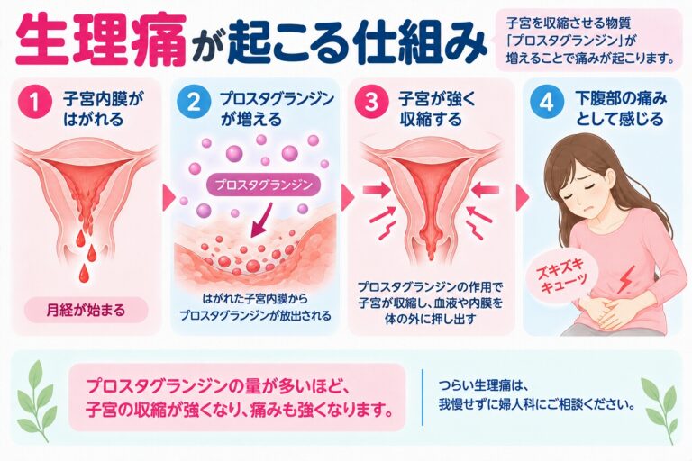 生理痛が起こる仕組みを解説したインフォグラフィック。月経で子宮内膜がはがれる際にプロスタグランジンが産生され、子宮の収縮が強くなることで下腹部痛などが起こる流れを紹介