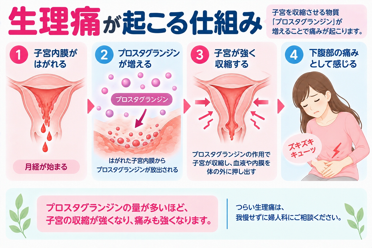 生理痛が起こる仕組みを解説したインフォグラフィック。月経で子宮内膜がはがれる際にプロスタグランジンが産生され、子宮の収縮が強くなることで下腹部痛などが起こる流れを紹介