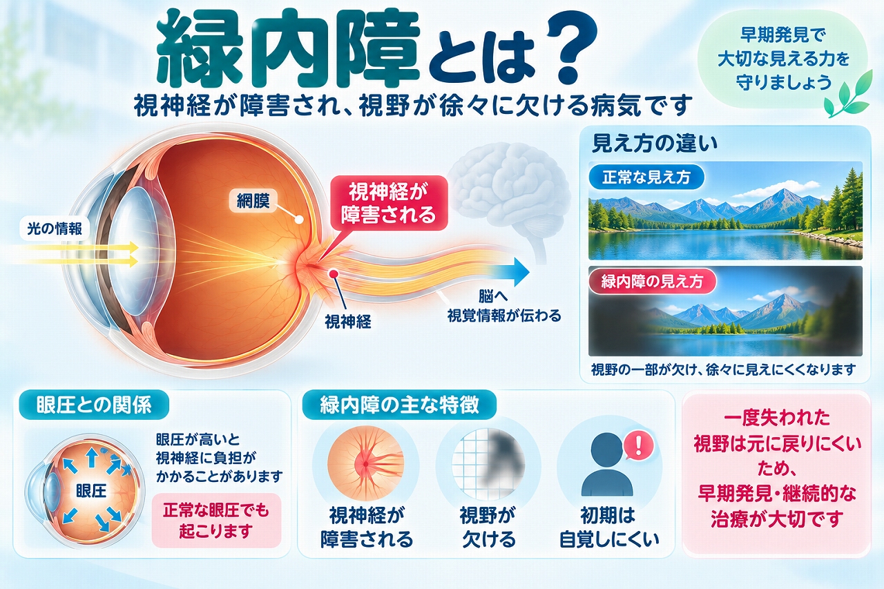 緑内障の仕組みを解説したインフォグラフィック。視神経が障害されることで視野が徐々に欠けて見えにくくなることや、眼圧との関係、正常眼圧でも発症すること、初期は自覚しにくい特徴を紹介