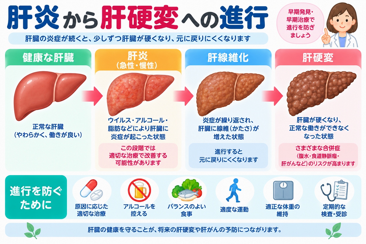 肝炎から肝硬変へ進行する仕組みを解説した医療インフォグラフィック。健康な肝臓、肝炎、肝線維化、肝硬変の4段階をイラストで比較。ウイルス性肝炎、アルコール、脂肪肝などの原因と、腹水、食道静脈瘤、肝がんなどの合併症、適切な治療、節酒、食事改善、定期検査による進行予防を紹介。