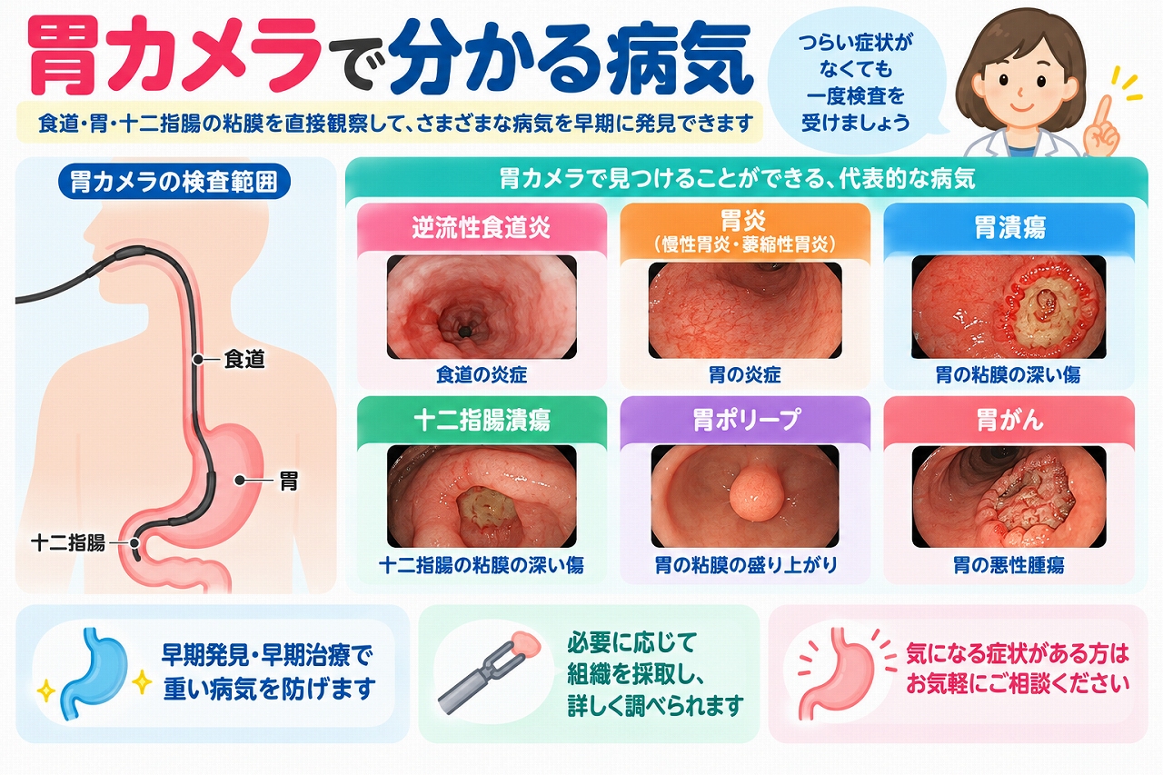胃カメラで発見できる代表的な病気を紹介した医療インフォグラフィック。食道・胃・十二指腸の検査範囲と、逆流性食道炎、胃炎、胃潰瘍、十二指腸潰瘍、胃ポリープ、胃がんの6種類を内視鏡画像で解説。胃カメラによる粘膜の観察や組織検査、早期発見の重要性を図解。