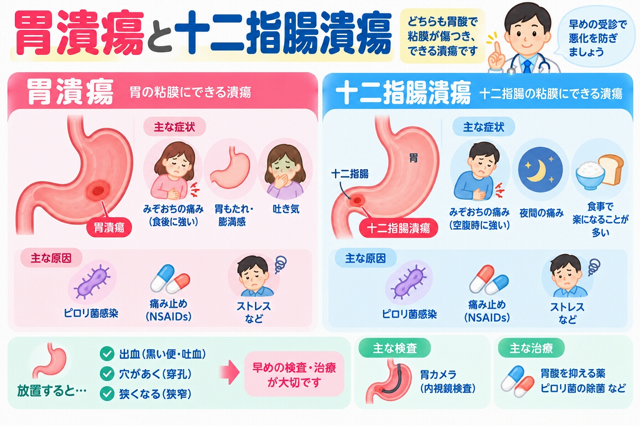 胃潰瘍と十二指腸潰瘍の違いを比較した医療インフォグラフィック。胃と十二指腸の潰瘍ができる場所、みぞおちの痛み、吐き気、胃もたれなどの症状を紹介。ピロリ菌感染やNSAIDsなどの主な原因、胃カメラによる検査、胃酸を抑える薬やピロリ菌除菌治療、出血・穿孔などの合併症を図解。