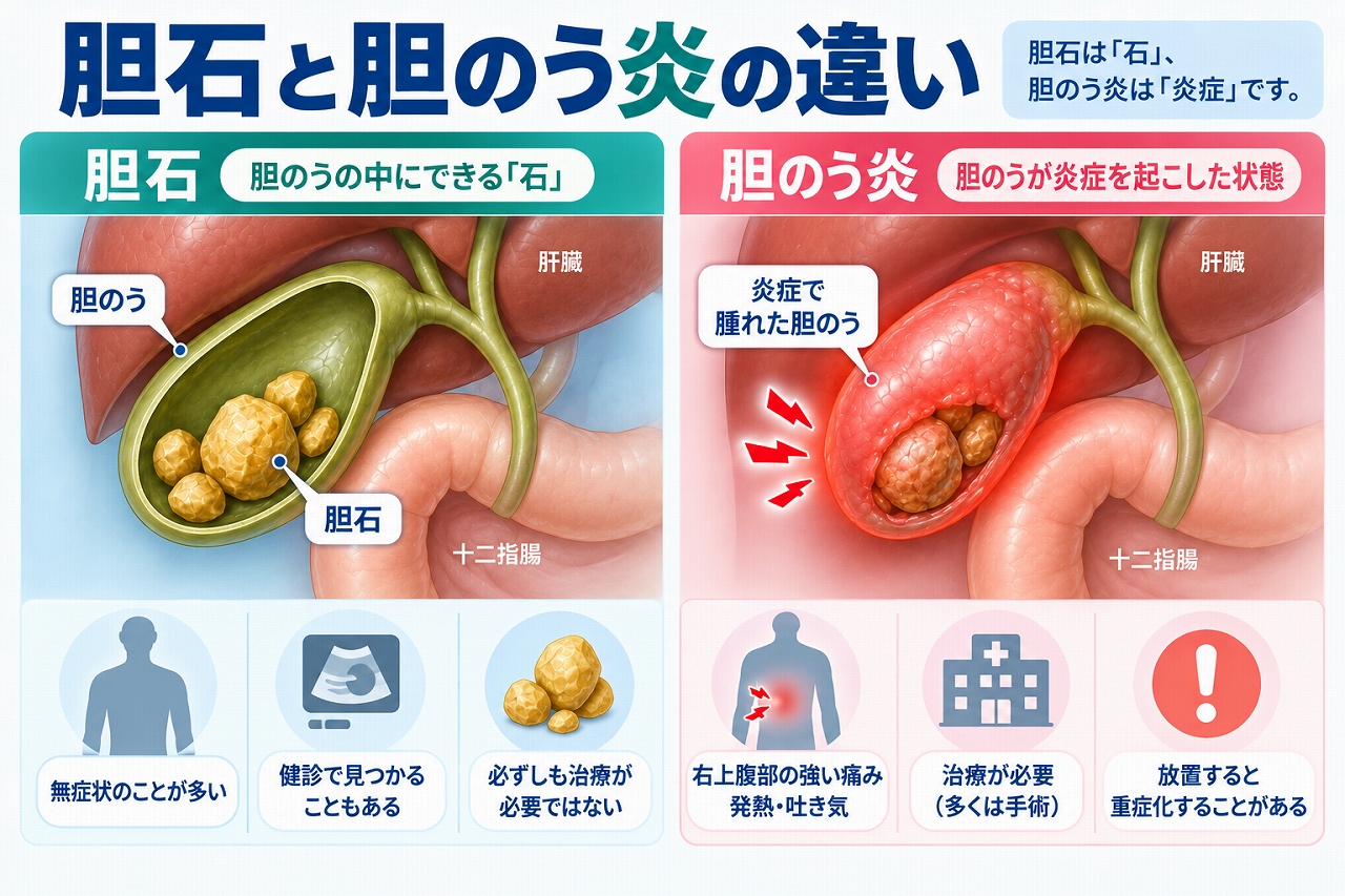 胆石と胆のう炎の違いを比較し、胆石は胆のう内にできる石で無症状のこともある一方、胆のう炎は胆のうに炎症が起こり、右上腹部の強い痛み・発熱・吐き気などが現れることを示した図