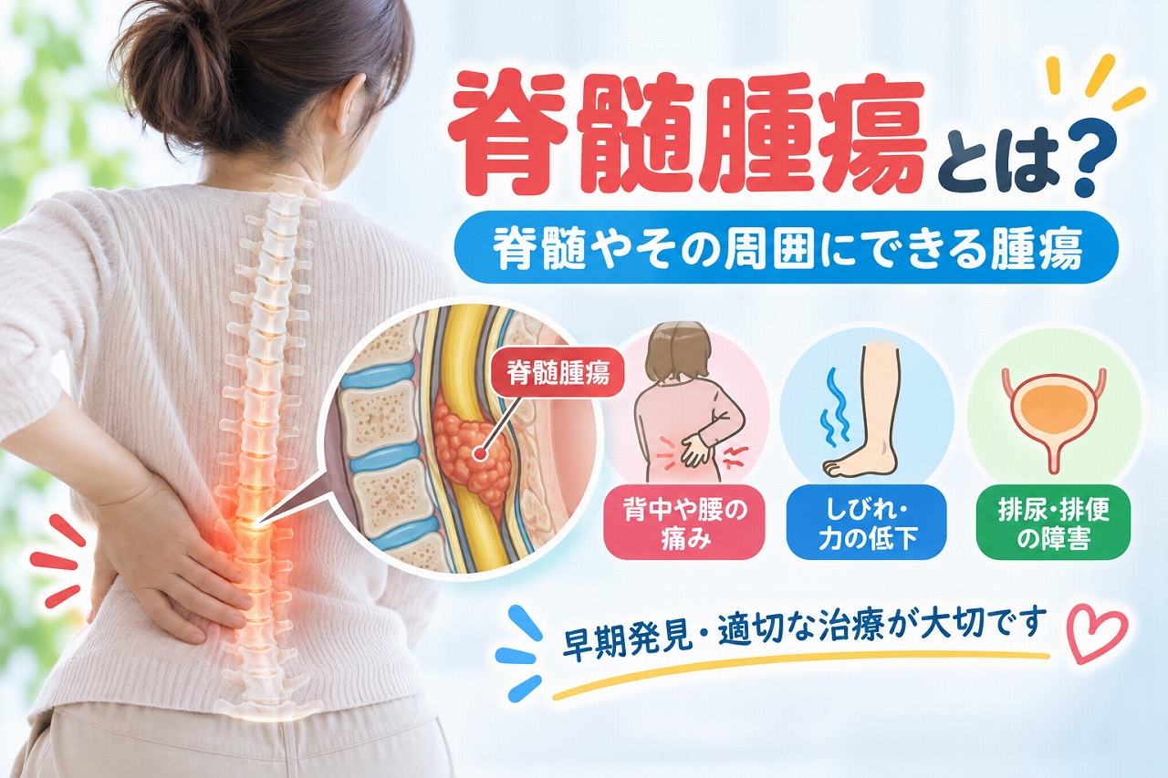脊髄腫瘍の発生部位と症状を解説した脳神経外科医療インフォグラフィック。腰に痛みを感じる女性と脊椎・脊髄の模式図を配置し、脊柱管内の腫瘍による脊髄や神経の圧迫を図解。背中や腰の痛み、手足のしびれ・筋力低下、排尿・排便障害の3つの代表的な症状を示した画像。