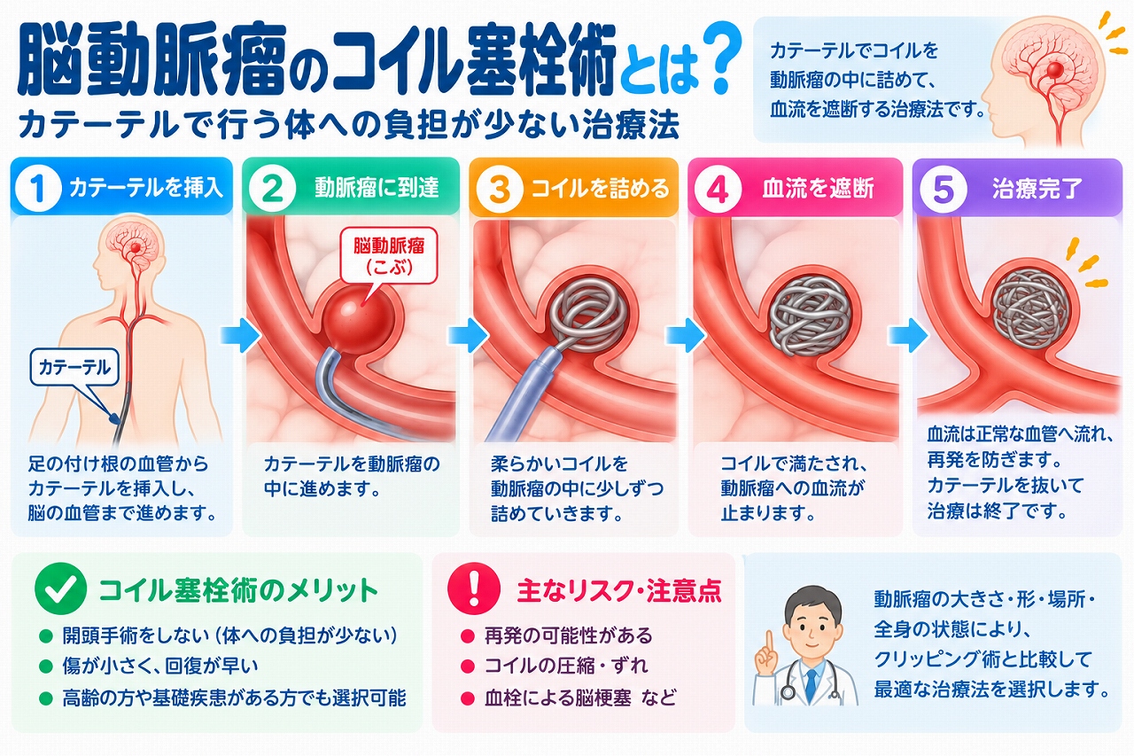 脳動脈瘤のコイル塞栓術の仕組みと治療手順を解説した医療インフォグラフィック。足の付け根などの血管からカテーテルを挿入し、脳動脈瘤の内部にプラチナ製コイルを詰めて血流を減らす治療を5段階で図解。開頭手術を必要としないメリットや、脳梗塞、動脈瘤の再開通、追加治療などのリスク、クリッピング術との比較についても紹介。