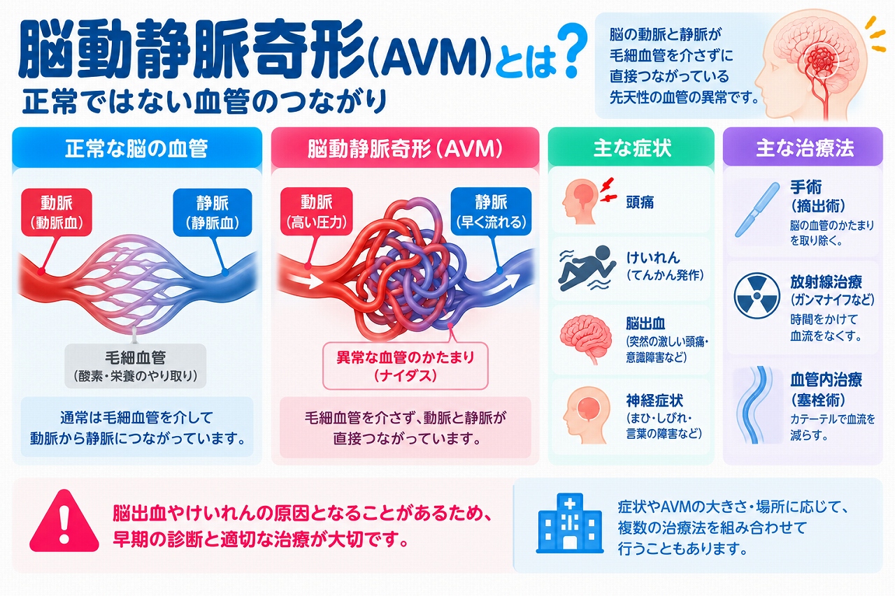 脳動静脈奇形（AVM）の仕組みや症状、治療法を解説した医療インフォグラフィック。正常な脳血管では動脈と静脈が毛細血管を介してつながるのに対し、AVMでは異常な血管のかたまり（ナイダス）を通じて直接つながる構造を比較。頭痛、てんかん発作、脳出血、麻痺・しびれなどの症状と、摘出手術・定位放射線治療・血管内塞栓術などの治療法を紹介。