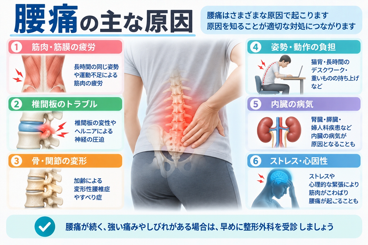 腰痛の主な原因として、筋肉や筋膜の疲労、椎間板のトラブル、骨や関節の変化、姿勢や動作による負担、内臓の病気、ストレスなどを示した図