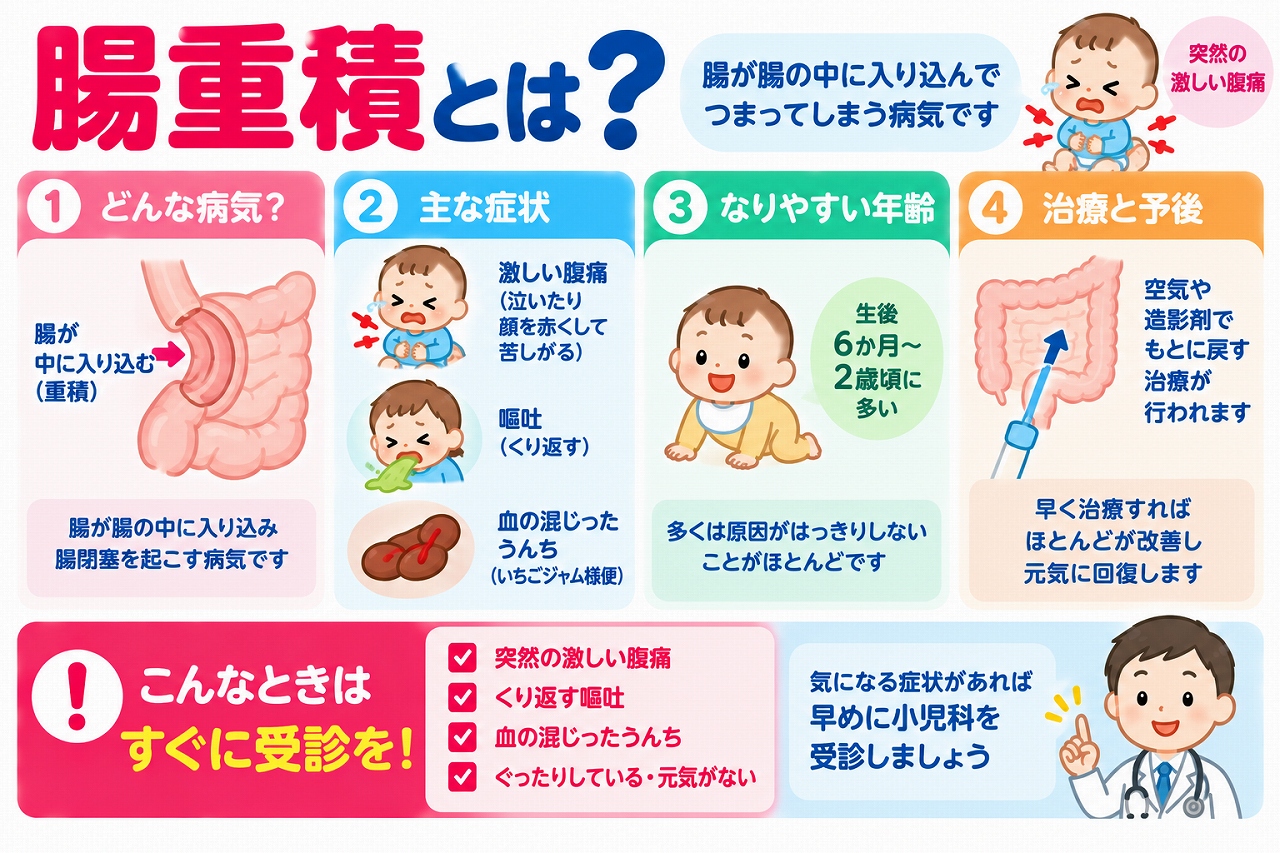 腸重積の仕組みや主な症状、発症しやすい年齢、治療法を解説した医療インフォグラフィック。腸の一部が隣の腸管内に入り込み、腸閉塞を起こす様子をイラストで紹介。突然の激しい腹痛、繰り返す嘔吐、血便、ぐったりするなどの症状と、空気や造影剤による整復治療、緊急受診の重要性を図解。