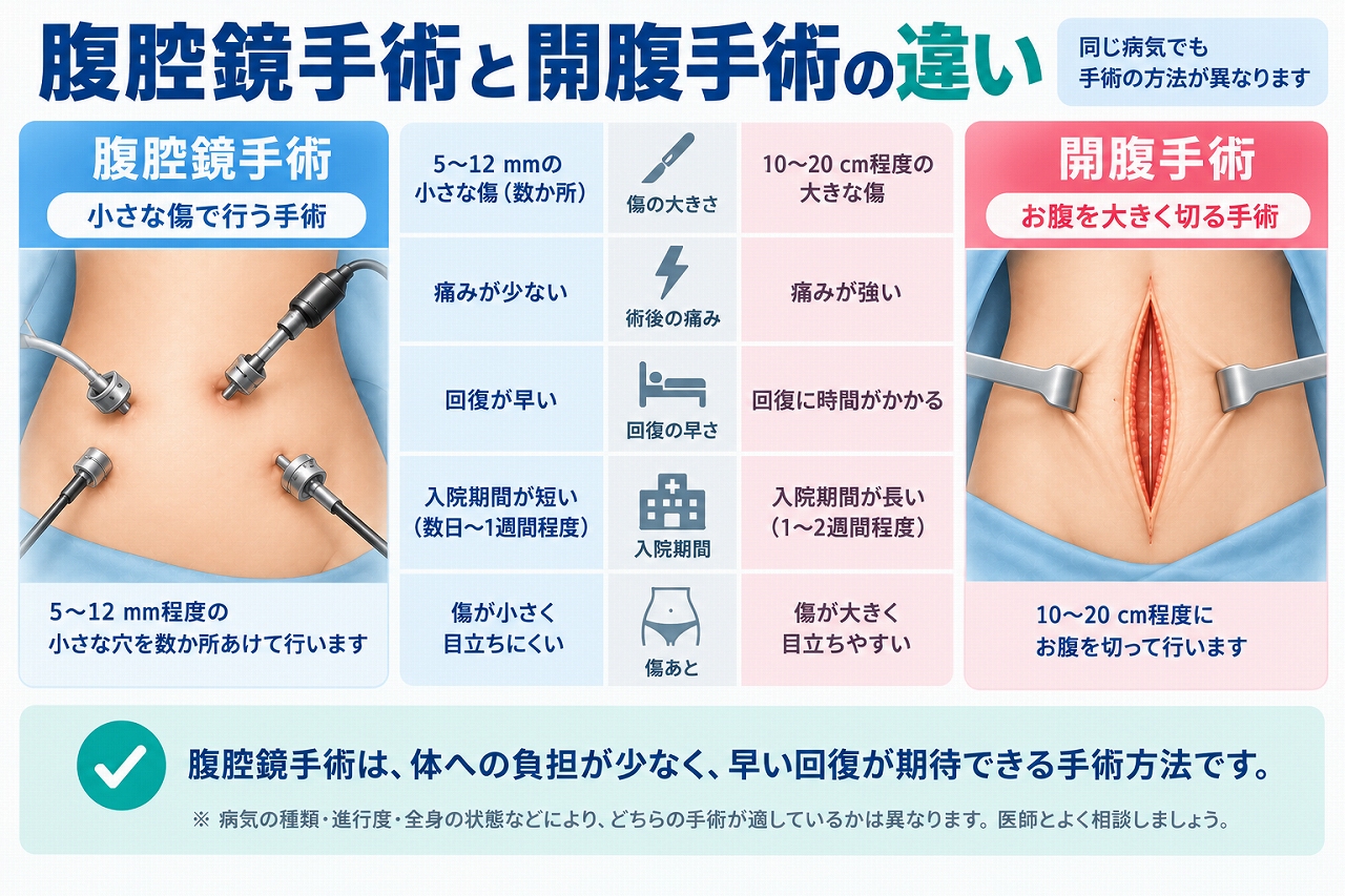 腹腔鏡手術と開腹手術の違いを、手術の傷の大きさ、術後の痛み、回復の早さ、入院期間、傷あとの特徴などから比較した患者教育用の図