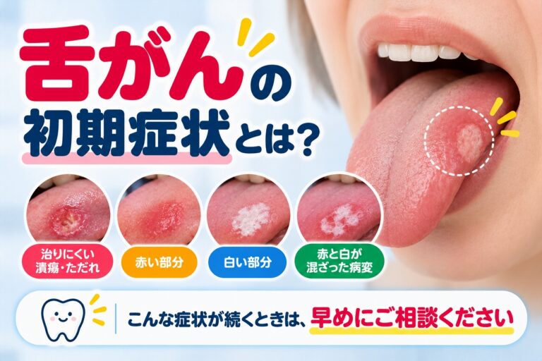 舌がんの初期症状として注意したい粘膜の変化を解説した歯科・口腔外科向け医療インフォグラフィック。舌の側面に生じた潰瘍状の病変を拡大し、治りにくい潰瘍やただれ、赤い部分、白い部分、赤色と白色が混在した病変の4つを比較。舌がんと口内炎は見た目だけでは区別できず、症状が続く場合は歯科口腔外科などでの診察が重要であることを伝える患者教育用画像。