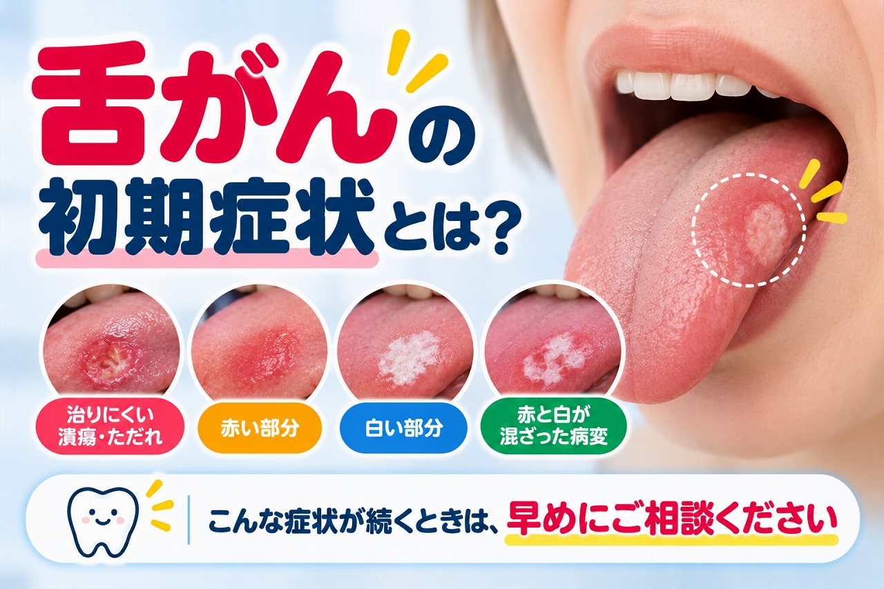 舌がんの初期症状として注意したい粘膜の変化を解説した歯科・口腔外科向け医療インフォグラフィック。舌の側面に生じた潰瘍状の病変を拡大し、治りにくい潰瘍やただれ、赤い部分、白い部分、赤色と白色が混在した病変の4つを比較。舌がんと口内炎は見た目だけでは区別できず、症状が続く場合は歯科口腔外科などでの診察が重要であることを伝える患者教育用画像。