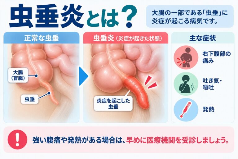 虫垂炎とは？右下腹部の痛み・症状と炎症が起こる仕組み