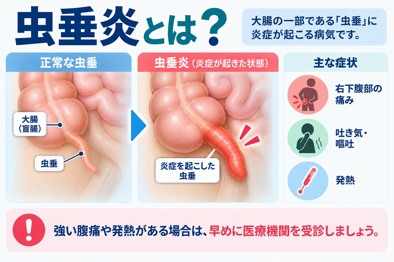 虫垂炎とは大腸の始まりにある虫垂に炎症が起こる病気で、正常な虫垂と炎症を起こした虫垂の違いや、右下腹部の痛み・吐き気・嘔吐・発熱などの主な症状を示した図