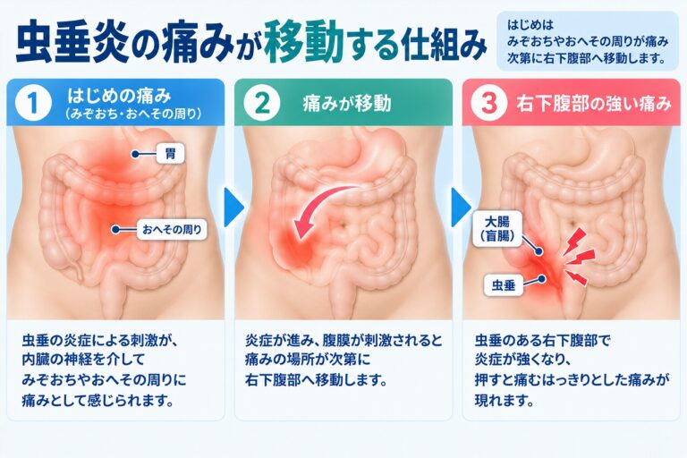 虫垂炎の痛みが移動する仕組み｜みぞおち・へそ周りから右下腹部へ