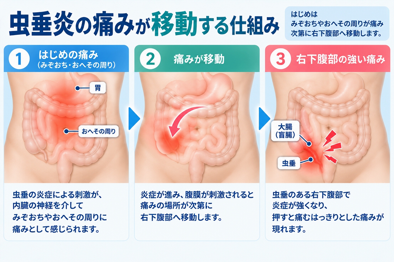 虫垂炎の痛みが移動する仕組みを、初期のみぞおちやへそ周りの痛みから、炎症が進むにつれて右下腹部に痛みが移り、局所的な強い痛みになるまでの流れで示した図