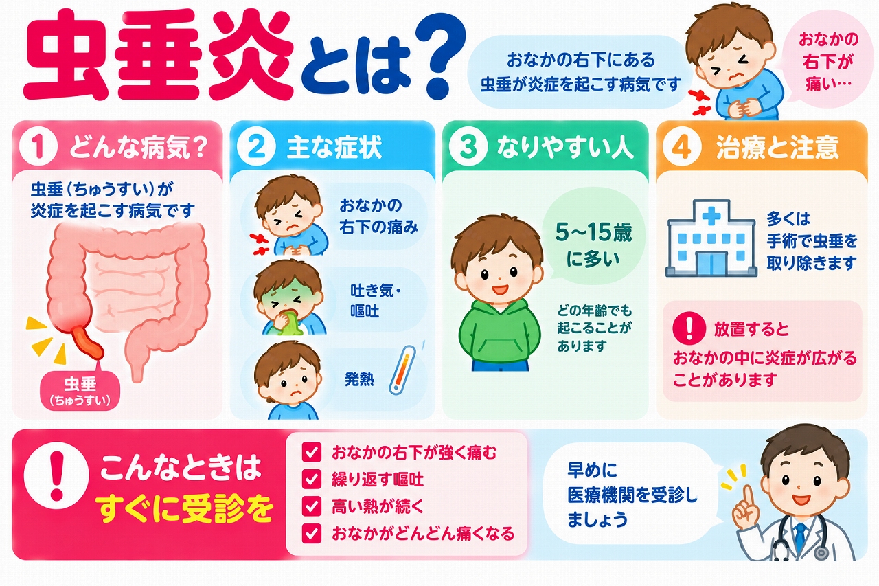 虫垂炎の仕組みや症状、治療法を解説した医療インフォグラフィック。大腸の始まりにある虫垂に炎症が起こる様子をイラストで紹介。右下腹部の痛み、吐き気、嘔吐、発熱などの症状と、子どもにも起こる病気であること、手術などの治療法、早期受診の重要性を図解。