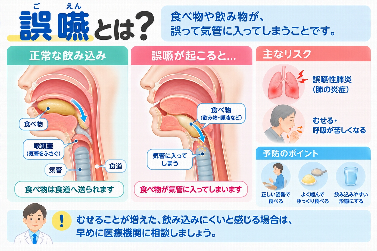 誤嚥の仕組みやリスクを解説したインフォグラフィック。正常な嚥下では食べ物が食道へ送られるのに対し、誤嚥では食べ物や飲み物、唾液などが誤って気管に入り、むせや誤嚥性肺炎につながることや予防のポイントを紹介