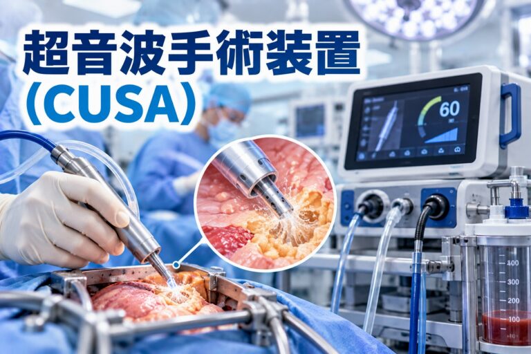超音波手術装置（CUSA）の医療用アイキャッチ画像。手術室で医師が超音波吸引装置のハンドピースを操作し、組織を破砕・吸引する様子を描いている。右側には装置本体、操作モニター、吸引チューブ、回収容器を配置し、中央の拡大図では超音波振動による組織の破砕と吸引の仕組みを模式的に表現している。