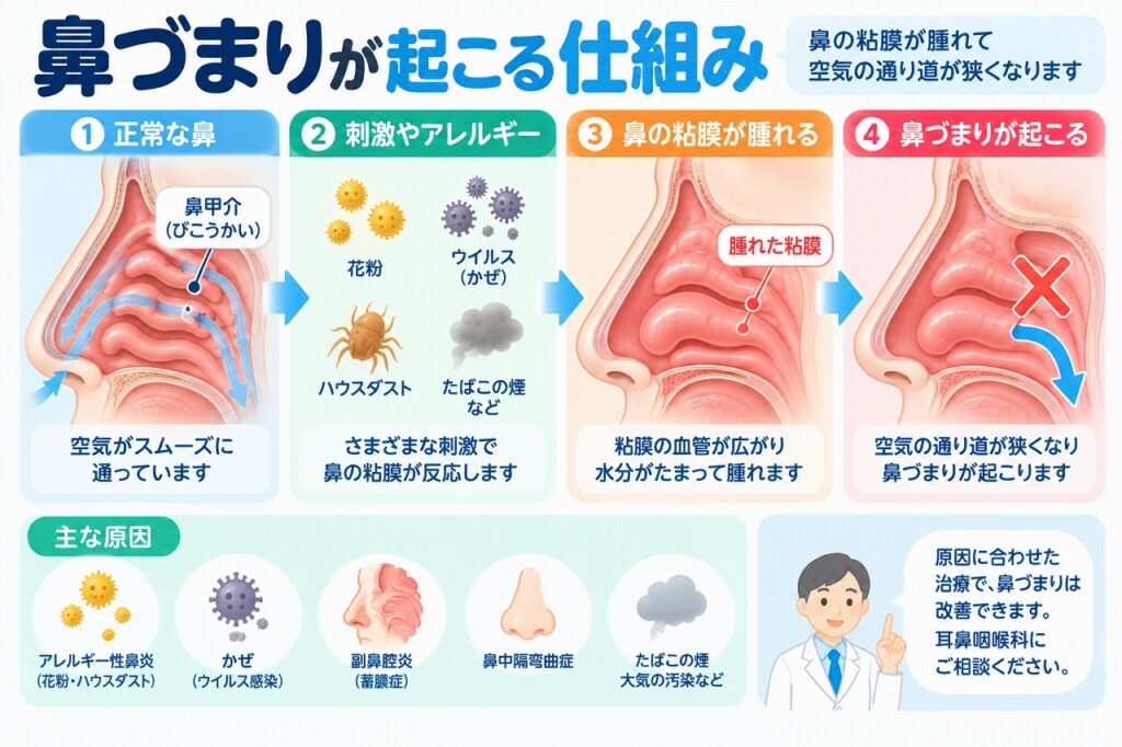 鼻づまりが起こる仕組み｜鼻の粘膜が腫れて空気の通り道が狭くなる原因