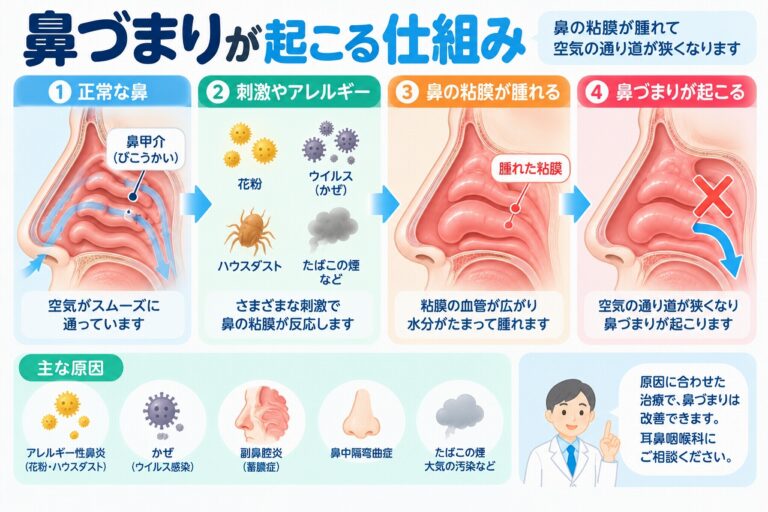 鼻づまりが起こる仕組みを解説したインフォグラフィック。花粉やハウスダスト、風邪のウイルスなどの刺激で鼻粘膜が反応し、血管の拡張やむくみによって空気の通り道が狭くなる流れと、アレルギー性鼻炎・副鼻腔炎など主な原因を紹介