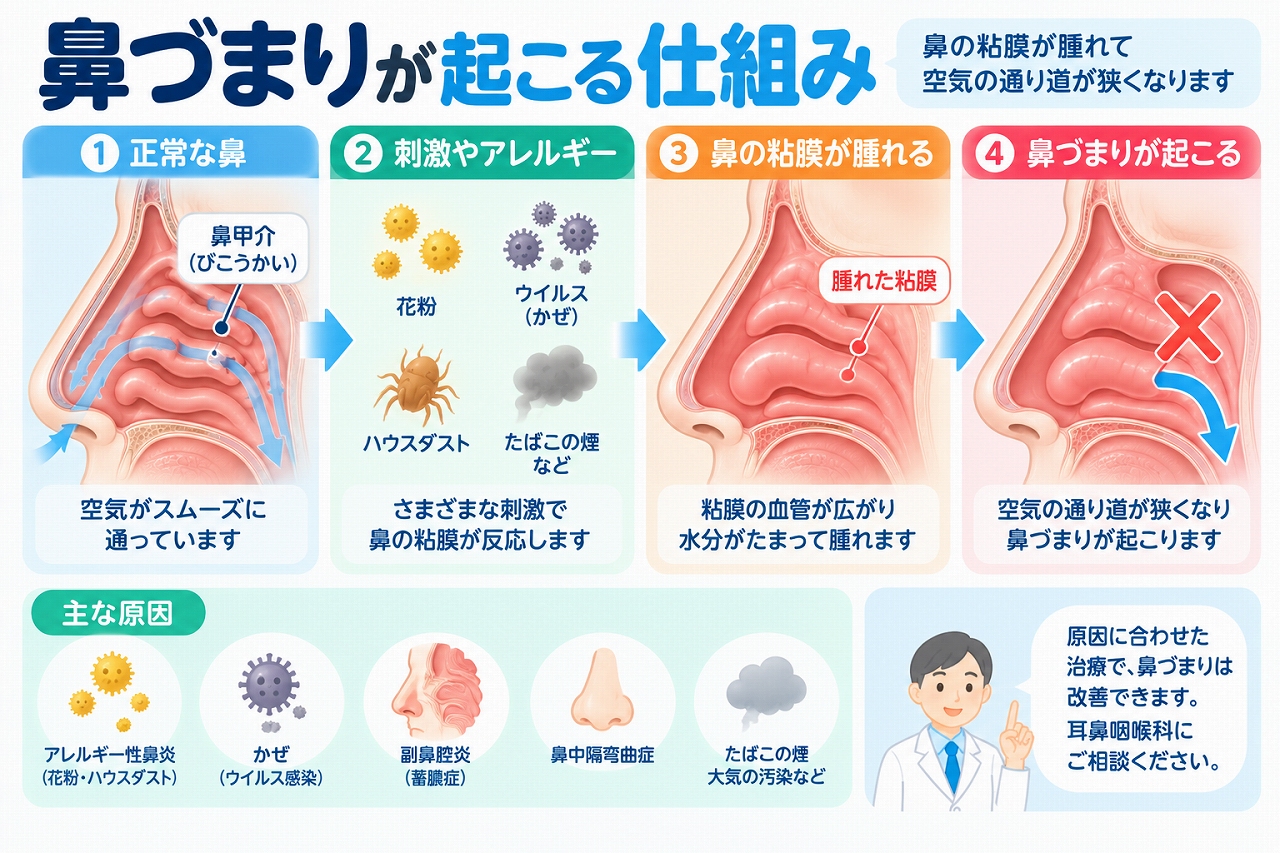 鼻づまりが起こる仕組みを解説したインフォグラフィック。花粉やハウスダスト、風邪のウイルスなどの刺激で鼻粘膜が反応し、血管の拡張やむくみによって空気の通り道が狭くなる流れと、アレルギー性鼻炎・副鼻腔炎など主な原因を紹介