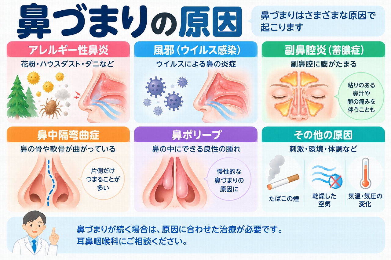 鼻づまりの主な原因を解説したインフォグラフィック。アレルギー性鼻炎、風邪、副鼻腔炎、鼻中隔弯曲症、鼻ポリープなど、鼻の空気の通り道が狭くなる代表的な原因と特徴を紹介