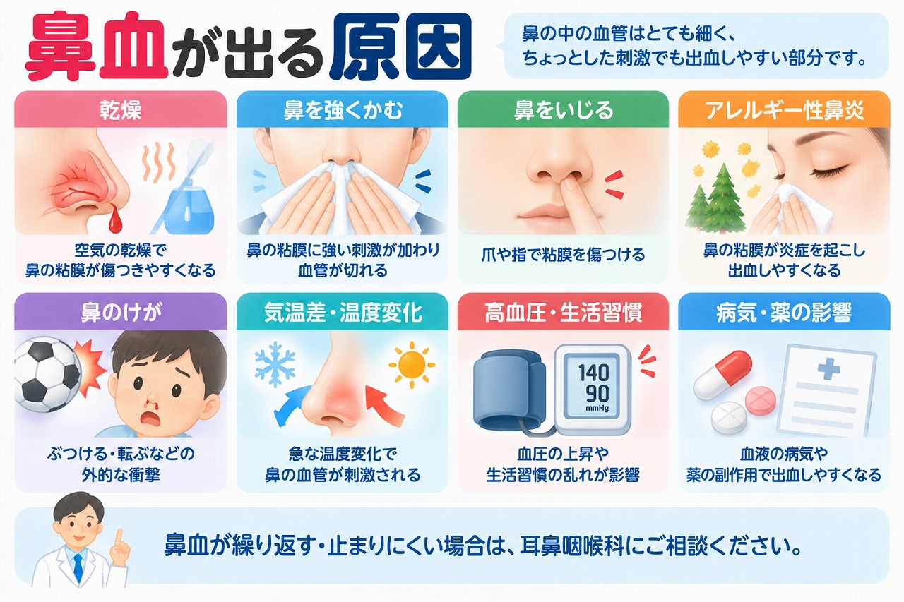 鼻血が出る主な原因を解説したインフォグラフィック。鼻の乾燥、強く鼻をかむ、鼻をいじる、アレルギー性鼻炎、鼻への外傷、気温や湿度の変化、血圧や一部の病気・薬など、鼻出血につながる原因を紹介
