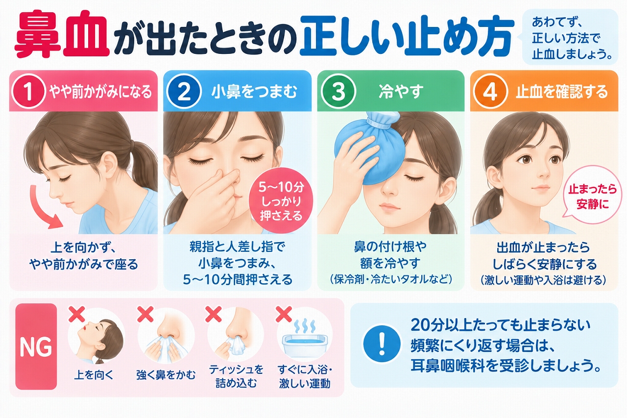 鼻血が出たときの正しい止め方を解説したインフォグラフィック。やや前かがみになり、小鼻を指でつまんで圧迫する基本的な止血方法と、上を向く、強く鼻をかむ、ティッシュを詰め込むなど避けたい行動、受診の目安を紹介